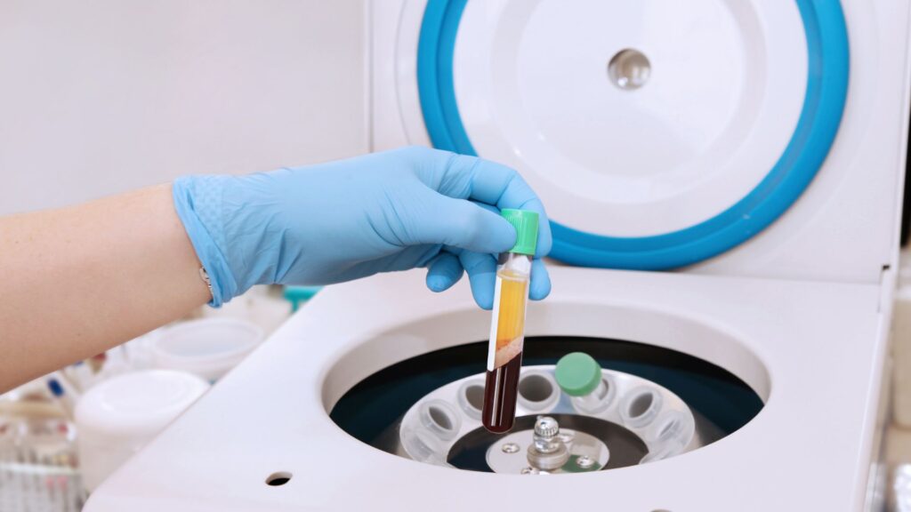 Le plasma riche en plaquettes (PRP) est obtenu par centrifugation du sang